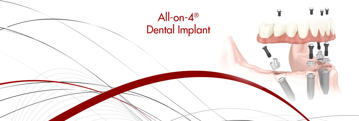 Visalia All-on-4 Dental Implants