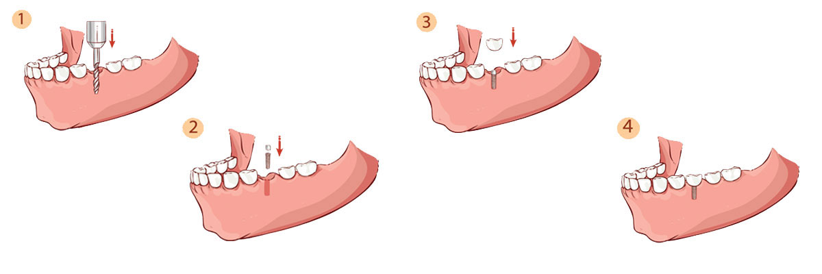 Visalia Dental Implant Restoration