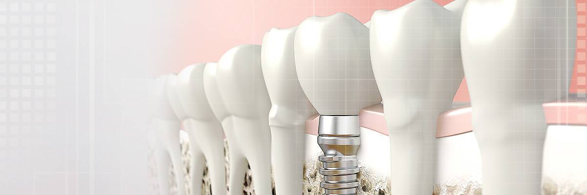 Visalia Dental Prosthetics