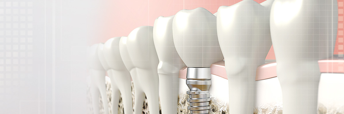 Visalia Implant Dentist