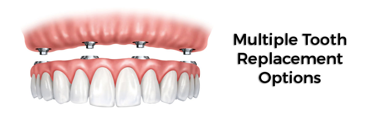 Visalia Multiple Teeth Replacement Options