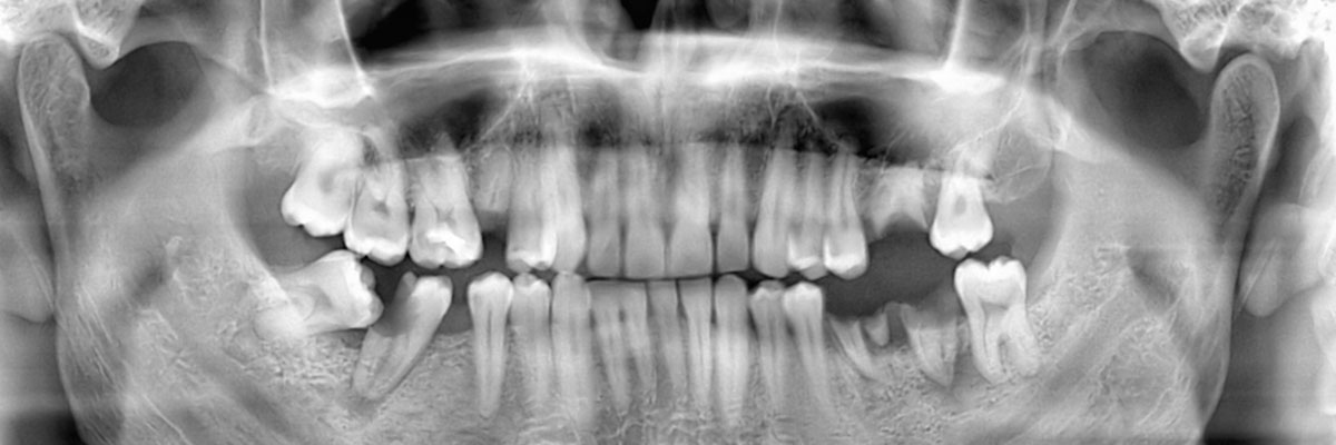 Visalia Options for Replacing Missing Teeth